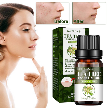 TEA TREE OIL &#8211; Ulje protiv akni